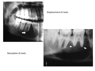 Radiographs in endodontics