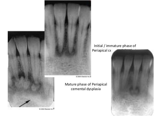 Radiographs in endodontics
