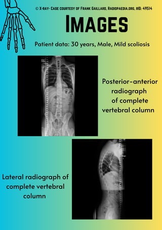 Images
© X-ray- Case courtesy of Frank Gaillard, Radiopaedia.org, rID: 49514
Posterior-anterior
radiograph
of complete
vertebral column
Lateral radiograph of
complete vertebral
column
Patient data: 30 years, Male, Mild scoliosis
 
