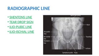 Stenton Line RADIOGRAPHY OF PELVIS AND HIPJOINTS.pptx