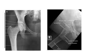 Hip Radiograph Radiopaedia RADIOGRAPHY OF PELVIS AND HIPJOINTS.pptx