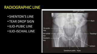 Radiography of Pelvis & Hip Joints - Saroj.pptx