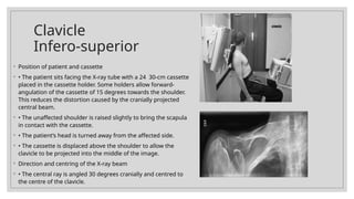 Comprehensive Radiography Techniques for Shoulder Imaging and Diagnosis ...