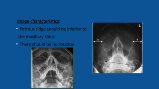 Radiography of skull [Autosaved].pptxriuyowioehgg | PPTX