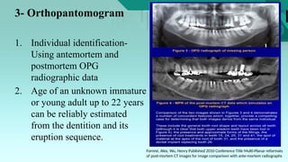 Role of radiography in forensic odontology.pptx