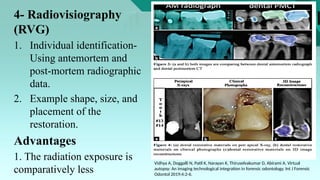 Role of radiography in forensic odontology.pptx