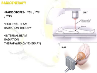 •RADISOTOPES- 60Co , 192Ir
, 137Cs
•EXTERNAL BEAM
RADIATION THERAPY
•INTERNAL BEAM
RADIATION
THERAPY(BRACHYTHERAPY)
EBRT
IBRT
 
