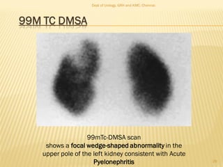 99M TC DMSA
29
99mTc-DMSA scan
shows a focal wedge-shaped abnormality in the
upper pole of the left kidney consistent with Acute
Pyelonephritis
Dept of Urology, GRH and KMC, Chennai.
 