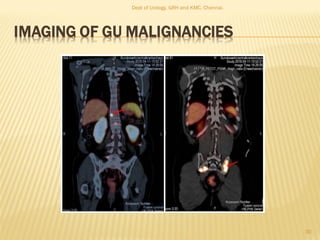 IMAGING OF GU MALIGNANCIES
30
Dept of Urology, GRH and KMC, Chennai.
 