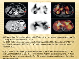 34
Differentiation of a localized clear cell RCC (A to C) from a benign renal oncocytoma (D to
F) using 99mTc-sestamibi SPECT/CT.
(A) CECT -heterogeneous mass in the left kidney . (B)Axial 99mTc-sestamibi SPECT (C)
axial 99mTc-sestamibi SPECT/ CT - NO radiotracer uptake. On HPE resected mass -
clear cell RCC.
(D) CECT - left-sided heterogeneousrenal mass (E)Axial 99mTc-sestamibi SPECT .(F)
axial 99mTc-sestamibi SPECT/CT - show intrinsic/highest radiotracer uptake, in those
parts of the mass (red arrowheads).On HPE resectedrenal mass biopsy confirmed as
Dept of Urology, GRH and KMC, Chennai.
 