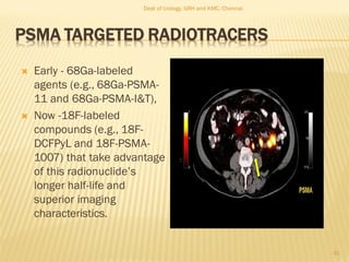 PSMA TARGETED RADIOTRACERS
 Early - 68Ga-labeled
agents (e.g., 68Ga-PSMA-
11 and 68Ga-PSMA-I&T),
 Now -18F-labeled
compounds (e.g., 18F-
DCFPyL and 18F-PSMA-
1007) that take advantage
of this radionuclide’s
longer half-life and
superior imaging
characteristics.
41
Dept of Urology, GRH and KMC, Chennai.
 