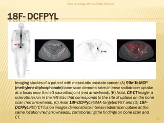 18F- DCFPYL
42
Imaging studies of a patient with metastatic prostate cancer. (A) 99mTc-MDP
(methylene diphosphonate) bone scan demonstrates intense radiotraceruptake
at a focus near the left sacroiliac joint (red arrowhead).(B) Axial, CE-CTimage- a
sclerotic lesion in the left iliac that corresponds to the site of uptake on the bone
scan (red arrowhead). (C) Axial 18F-DCFPyLPSMA-targeted PET and (D) 18F-
DCFPyL PET/CT fusion images demonstrate intense radiotracer uptake at the
same location (red arrowheads),corroborating the findings on bone scan and
CT.
Dept of Urology, GRH and KMC, Chennai.
 