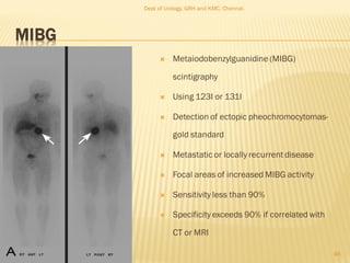 MIBG
 Metaiodobenzylguanidine (MIBG)
scintigraphy
 Using 123I or 131I
 Detection of ectopic pheochromocytomas-
gold standard
 Metastatic or locally recurrent disease
 Focal areas of increased MIBG activity
 Sensitivity less than 90%
 Specificity exceeds 90% if correlated with
CT or MRI
46
Dept of Urology, GRH and KMC, Chennai.
 