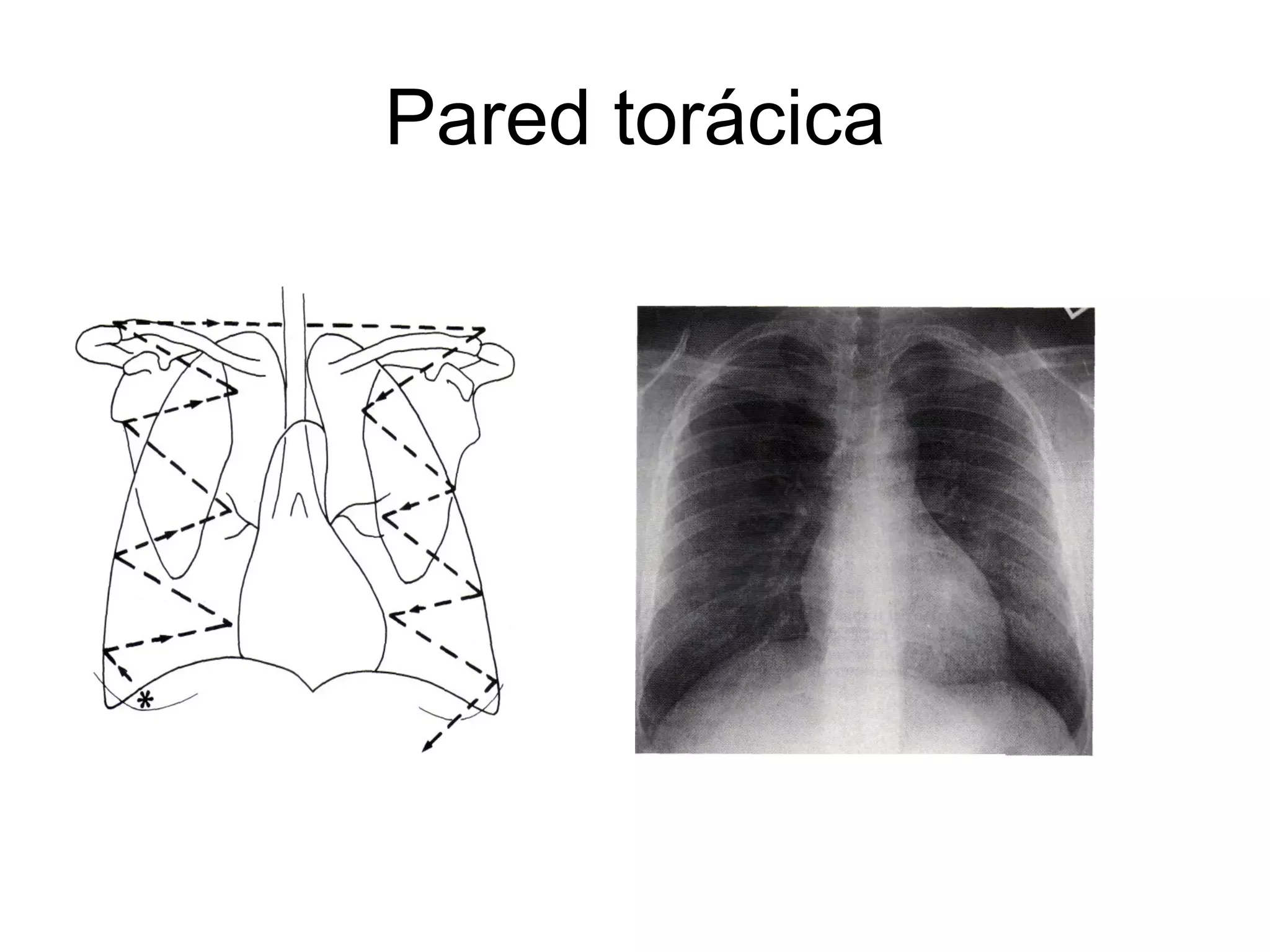 RadiologíA De TóRax Normal | PPT | Lung and Respiratory Health ...