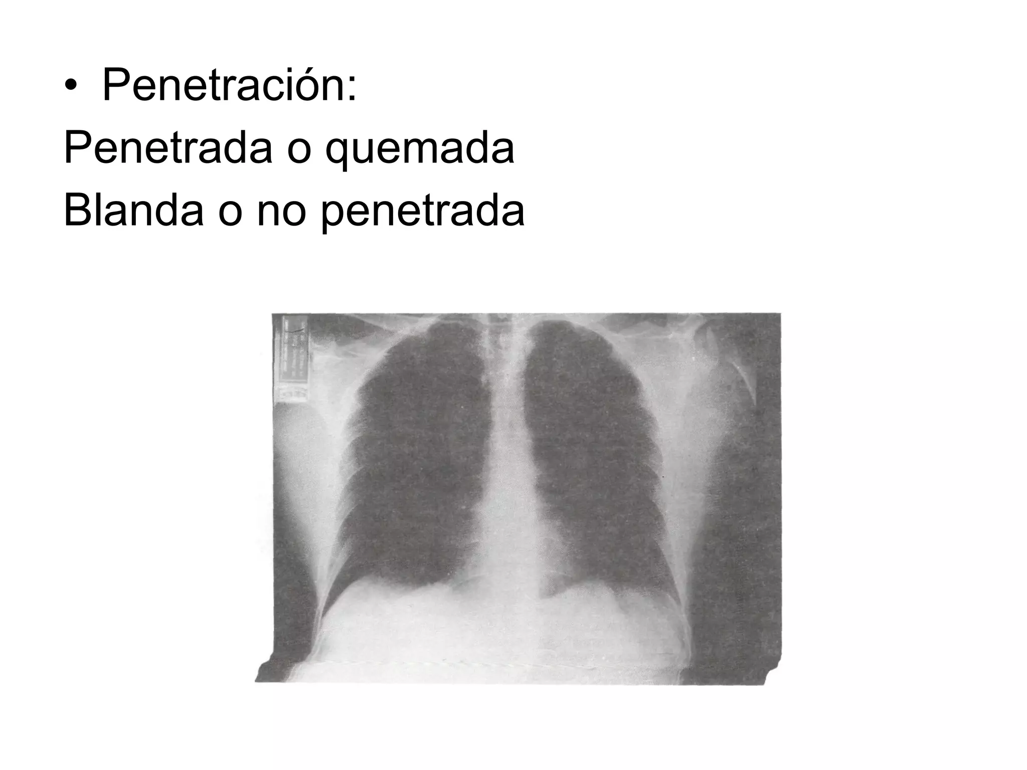 RadiologíA De TóRax Normal | PPT | Lung and Respiratory Health ...