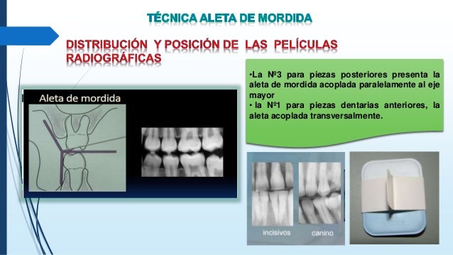 Radiología grupo-1-técnicas-intrabucales-aleta-de-mordida-oclusal-cla…