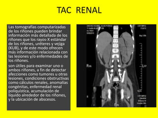 TAC RENAL
Las tomografías computarizadas
de los riñones pueden brindar
información más detallada de los
riñones que los rayos-X estándar
de los riñones, uréteres y vejiga
(KUB), y de este modo ofrecen
más información relacionada con
las lesiones y/o enfermedades de
los riñones.
son útiles para examinar uno o
ambos riñones, a fin de detectar
afecciones como tumores u otras
lesiones, condiciones obstructivas
como cálculos renales, anomalías
congénitas, enfermedad renal
poliquística, acumulación de
líquido alrededor de los riñones,
y la ubicación de abscesos.
 