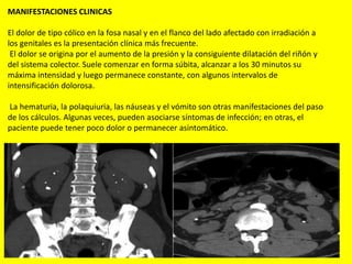 MANIFESTACIONES CLINICAS
El dolor de tipo cólico en la fosa nasal y en el flanco del lado afectado con irradiación a
los genitales es la presentación clínica más frecuente.
El dolor se origina por el aumento de la presión y la consiguiente dilatación del riñón y
del sistema colector. Suele comenzar en forma súbita, alcanzar a los 30 minutos su
máxima intensidad y luego permanece constante, con algunos intervalos de
intensificación dolorosa.
La hematuria, la polaquiuria, las náuseas y el vómito son otras manifestaciones del paso
de los cálculos. Algunas veces, pueden asociarse síntomas de infección; en otras, el
paciente puede tener poco dolor o permanecer asintomático.
 