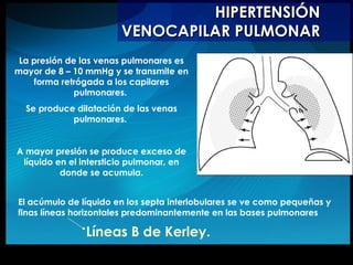HIPERTENSIÓN VENOCAPILAR PULMONAR La presión de las venas pulmonares es mayor de 8 – 10 mmHg y se transmite en forma retrógada a los capilares pulmonares.  Se produce dilatación de las venas pulmonares.  A mayor presión se produce exceso de líquido en el intersticio pulmonar, en donde se acumula. El acúmulo de líquido en los septa interlobulares se ve como pequeñas y finas líneas horizontales predominantemente en las bases pulmonares  Líneas B de Kerley. 