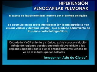 HIPERTENSIÓN VENOCAPILAR PULMONAR El exceso de líquido intersticial interfiere con el drenaje del líquido Se acumula en los septa interlobares (en la radiografía se ven cisuras visibles y derrame pleural), que produce borramiento de los senos costodiafragmáticos. Cuando la HVCP es lenta y crónica, existe vasoconstricción refleja de regiones basales que redistribuye el flujo a las regiones apicales por lo que el ensanchamiento venoso se ve en la mitad superior del tórax   “ Imagen en Asta de Ciervo”  