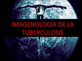 IMAGENOLOGÍA DE LA
TUBERCULOSIS
 