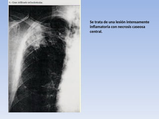Se trata de una lesión intensamente
inflamatoria con necrosis caseosa
central.
 