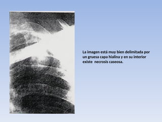 La imagen está muy bien delimitada por
un gruesa capa hialina y en su interior
existe necrosis caseosa.
 