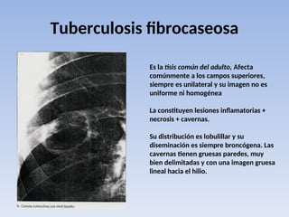 Tuberculosis fibrocaseosa
Es la tisis común del adulto, Afecta
comúnmente a los campos superiores,
siempre es unilateral y su imagen no es
uniforme ni homogénea
La constituyen lesiones inflamatorias +
necrosis + cavernas.
Su distribución es lobulillar y su
diseminación es siempre broncógena. Las
cavernas tienen gruesas paredes, muy
bien delimitadas y con una imagen gruesa
lineal hacia el hilio.
 