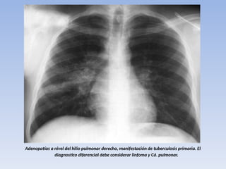 Adenopatías a nivel del hilio pulmonar derecho, manifestación de tuberculosis primaria. El
diagnostico diferencial debe considerar linfoma y Cá. pulmonar.
 