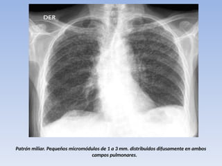 Patrón miliar. Pequeños micromódulos de 1 a 3 mm. distribuidos difusamente en ambos
campos pulmonares.
 