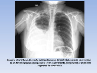 Derrame pleural basal. El estudio del líquido pleural demostró tuberculosis. La presencia
de un derrame pleural en un paciente joven relativamente asintomático es altamente
sugerente de tuberculosis.
 