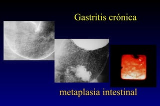 Gastritis crónica metaplasia intestinal 