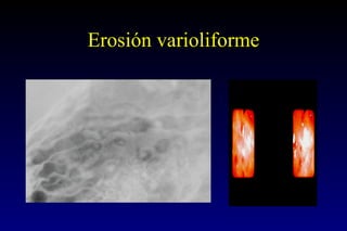 Erosión varioliforme 
