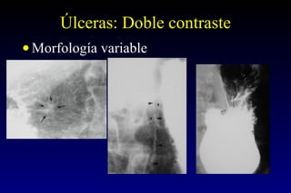 Úlceras: Doble contraste Morfología variable 