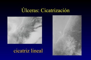 Úlceras: Cicatrización cicatriz lineal 