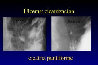Úlceras: cicatrización cicatriz puntiforme 