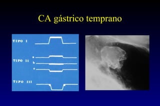 CA gástrico temprano 