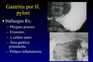Gastritis por H. pylori Hallazgos Rx: Pliegues gruesos Erosiones    calibre antro Área gástrica prominente Pólipos inflamatorios 