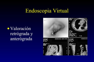 Endoscopia Virtual Valoración retrógrada y anterógrada  