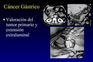 Cáncer Gástrico Valoración del tumor primario y extensión extraluminal 