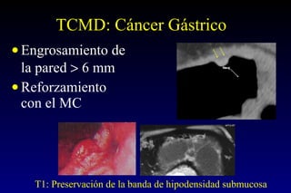 TCMD: Cáncer Gástrico  Engrosamiento de la pared    6 mm Reforzamiento con el MC T1: Preservación de la banda de hipodensidad submucosa 