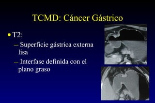 TCMD: Cáncer Gástrico T2: Superficie gástrica externa lisa Interfase definida con el plano graso  