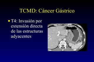 TCMD: Cáncer Gástrico  T4: Invasión por extensión directa  de las estructuras adyacentes  
