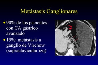 Metástasis Ganglionares 90% de los pacientes con CA gástrico avanzado 15%: metástasis a ganglio de Virchow (supraclavicular izq) 