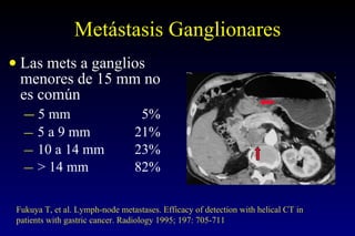 Metástasis Ganglionares Las mets a ganglios menores de 15 mm no es común 5 mm     5% 5 a 9 mm 21% 10 a 14 mm 23% > 14 mm 82% Fukuya T, et al. Lymph-node metastases. Efficacy of detection with helical CT in patients with gastric cancer. Radiology 1995; 197: 705-711 