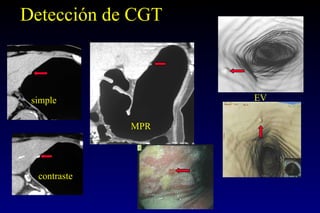 Detección de CGT simple contraste MPR EV 