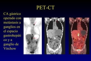 PET-CT CA gástrico operado con metástasis a ganglios en el espacio gastrohepático y a ganglio de Virchow 