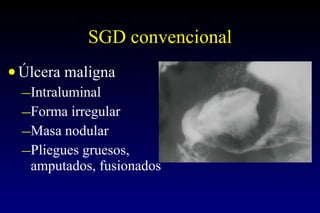 SGD convencional Úlcera maligna Intraluminal Forma irregular Masa nodular Pliegues gruesos, amputados, fusionados 