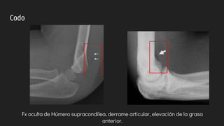 radiologia-fracturas-mas-comun-en-pediatr-a-pptx