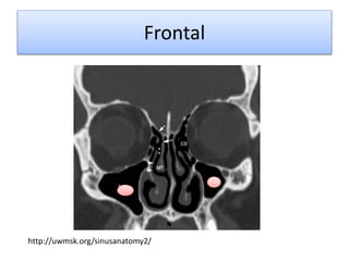 Frontal
http://uwmsk.org/sinusanatomy2/
 